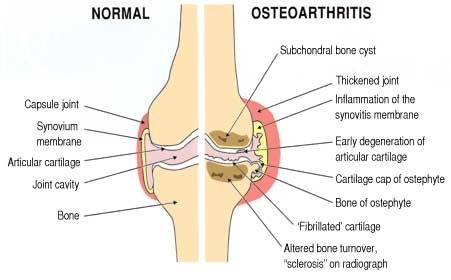 arthritic joint 2