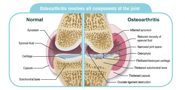 Arthritic knee