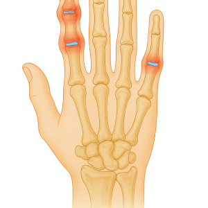 Medial Epicondylopathy