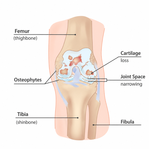 Knee OA