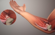 Golfers-Elbow_SAG