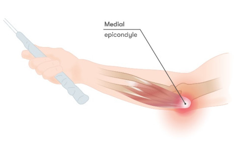 Medial Epicondylopathy