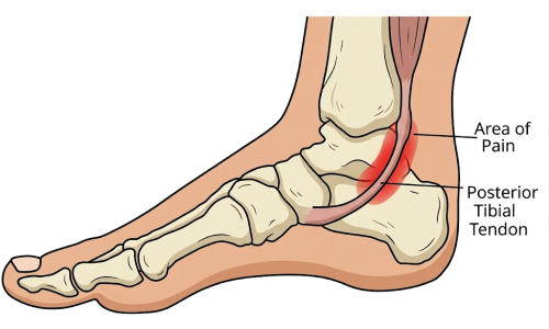 Tibialis Posterior Tendinopathy