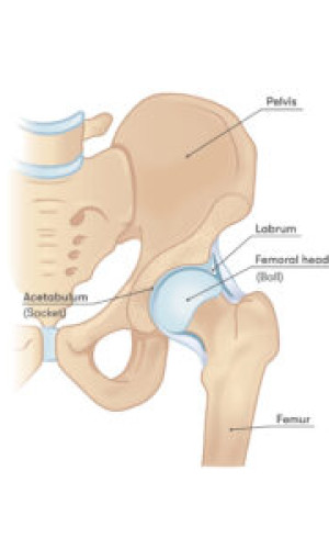 Greater Trochanteric Pain Syndrome