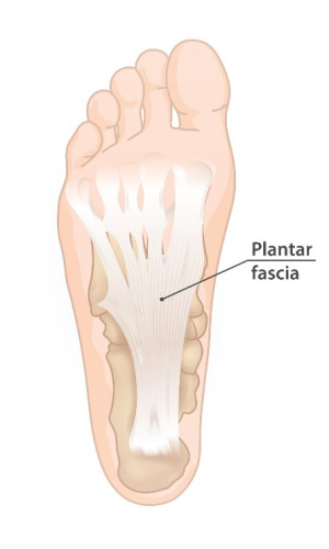 Plantar Fasciitis
