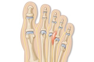 neuroma