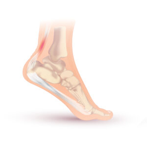 Achilles Tendinopathy