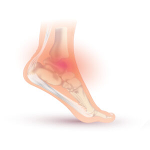 Foot and Ankle Osteoarthritis