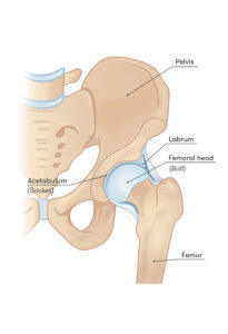 Greater Trochanteric Pain Syndrome
