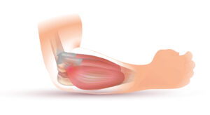 Lateral Epicondylopathy